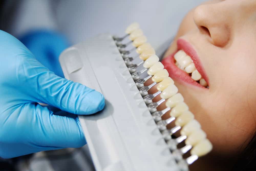 Dental Tooth Bonding, Cosmetic Dentist Orange Woodbridge Milford CT