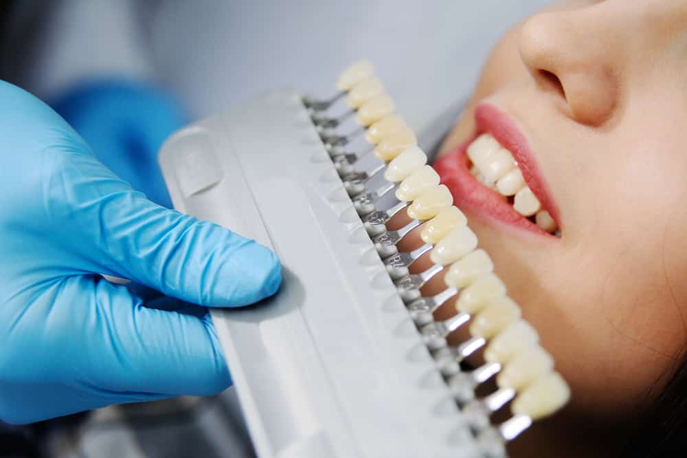 Dental Tooth Bonding  Cosmetic Dentist Orange Woodbridge Milford