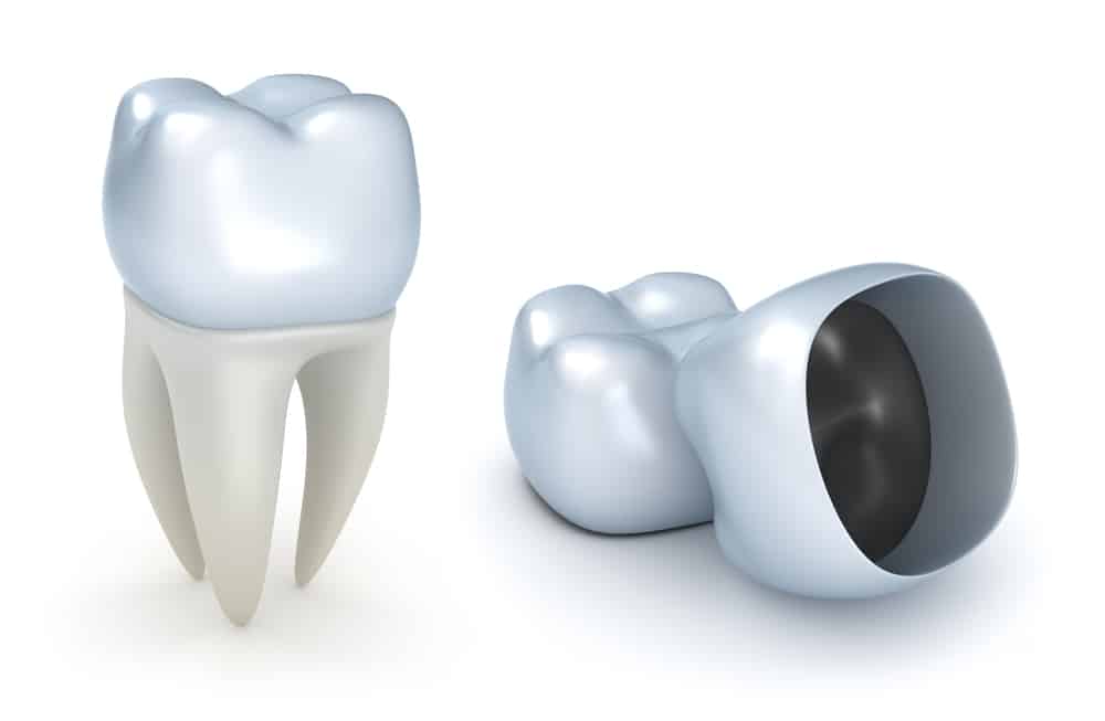 Dental Crowns: What Do They Do? | Absolute Dental Care
