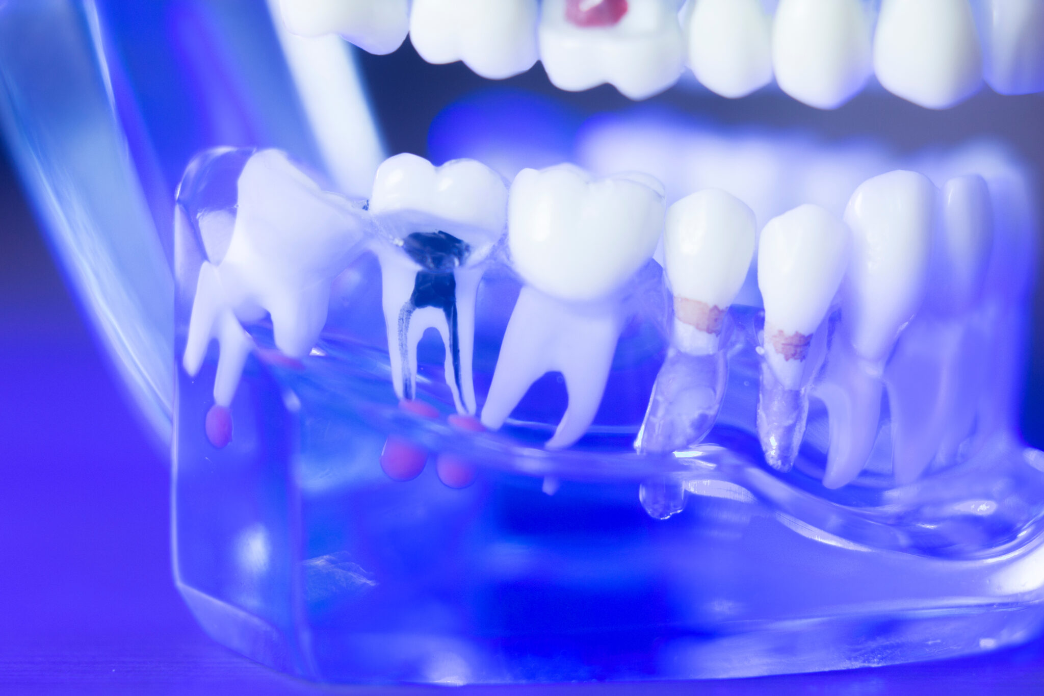 root-canal-therapy-in-wainwright-wainwright-dental-care