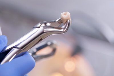 virginia tooth extraction